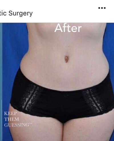 Breast and Body Before & After Patient #8389
