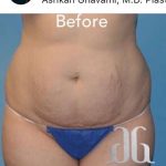 Breast and Body Before & After Patient #8389