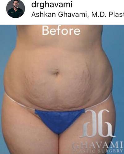 Breast and Body Before & After Patient #8389