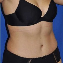 Breast and Body Before & After Patient #8386