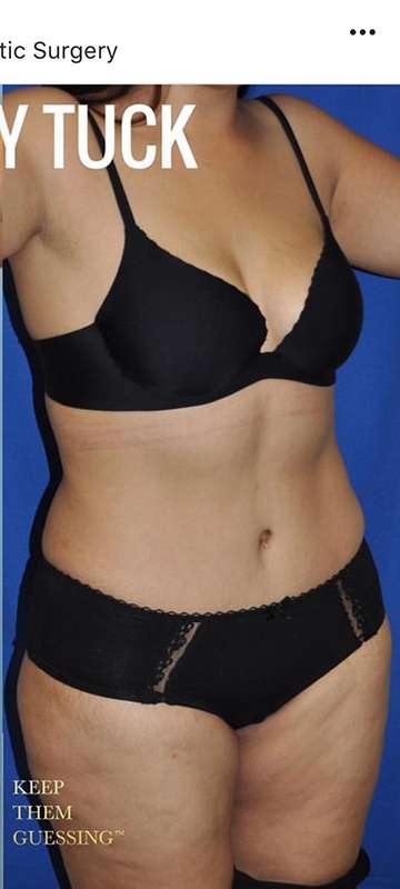 Breast and Body Before & After Patient #8386
