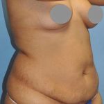 Breast and Body Before & After Patient #8386