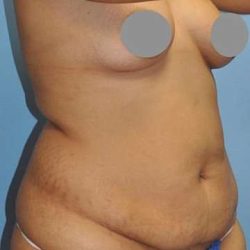 Breast and Body Before & After Patient #8386