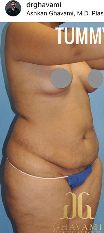 Breast and Body Before & After Patient #8386