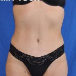 Breast and Body Before & After Patient #8383