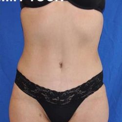 Breast and Body Before & After Patient #8383