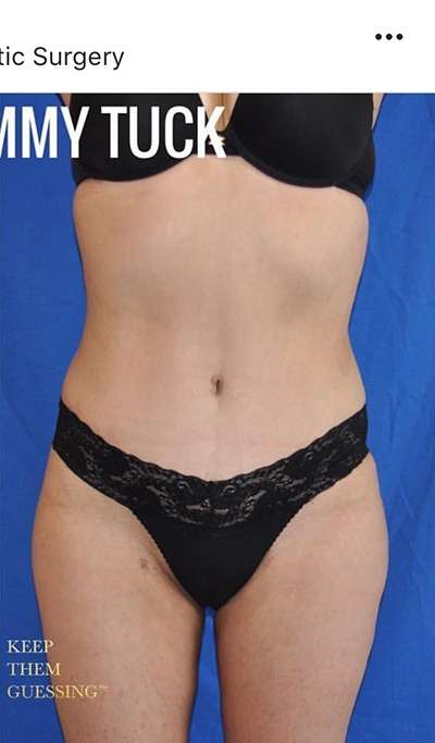 Breast and Body Before & After Patient #8383
