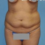 Breast and Body Before & After Patient #8383