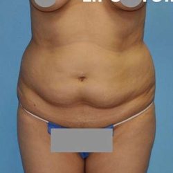Breast and Body Before & After Patient #8383