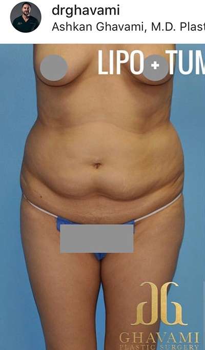Breast and Body Before & After Patient #8383