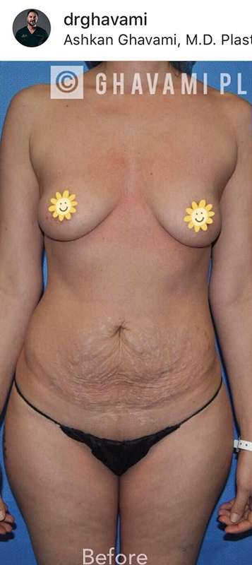 Breast and Body Before & After Patient #8380