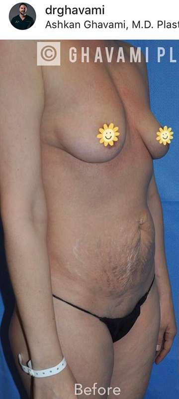 Breast and Body Before & After Patient #8380