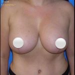 Breast and Body Before & After Patient #8375