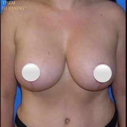 Breast and Body Before & After Patient #8375