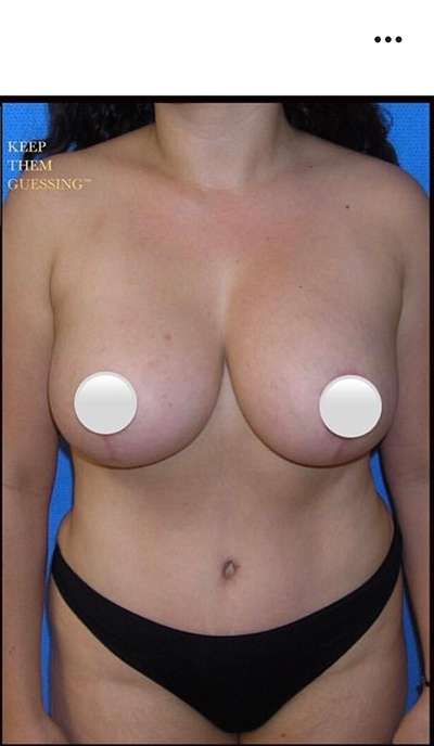 Breast and Body Before & After Patient #8375