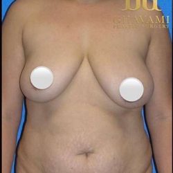 Breast and Body Before & After Patient #8375