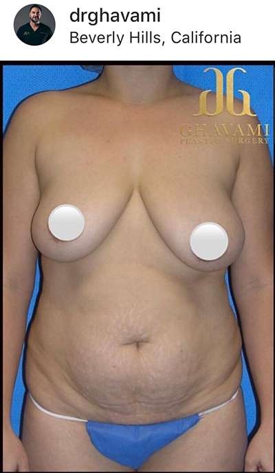 Breast and Body Before & After Patient #8375