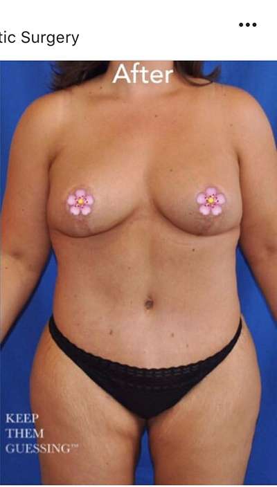 Breast and Body Before & After Patient #8372