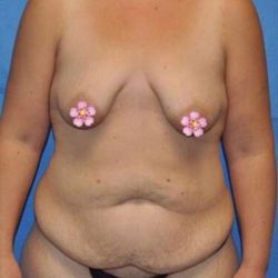 Breast and Body Before & After Patient #8372