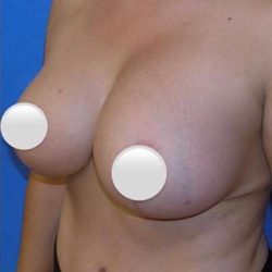 Breast and Body Before & After Patient #8369