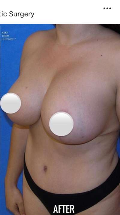 Breast and Body Before & After Patient #8369