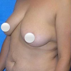 Breast and Body Before & After Patient #8369