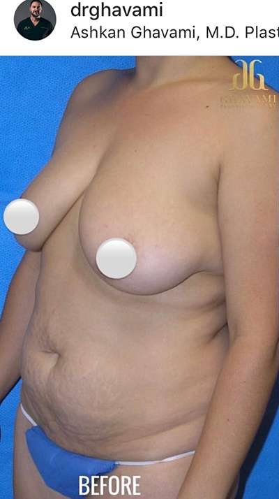 Breast and Body Before & After Patient #8369