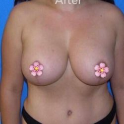 Breast and Body Before & After Patient #8366
