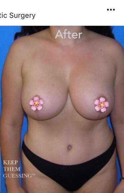 Breast and Body Before & After Patient #8366