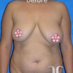 Breast and Body Before & After Patient #8366