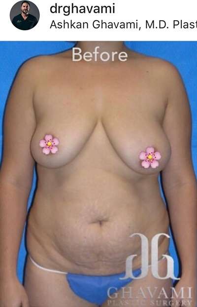 Breast and Body Before & After Patient #8366