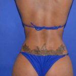 Breast and Body Before & After Patient #8363