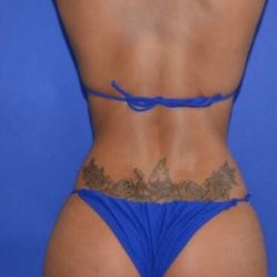 Breast and Body Before & After Patient #8363