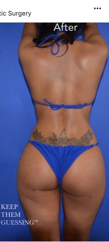 Breast and Body Before & After Patient #8363
