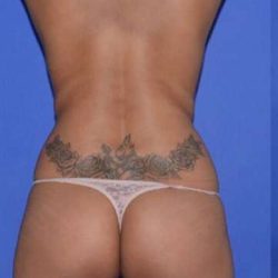 Breast and Body Before & After Patient #8363