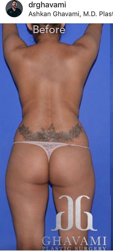 Breast and Body Before & After Patient #8363