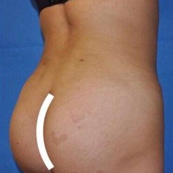 Breast and Body Before & After Patient #8360