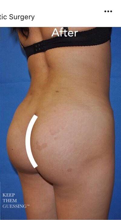 Breast and Body Before & After Patient #8360