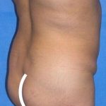 Breast and Body Before & After Patient #8360