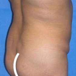 Breast and Body Before & After Patient #8360