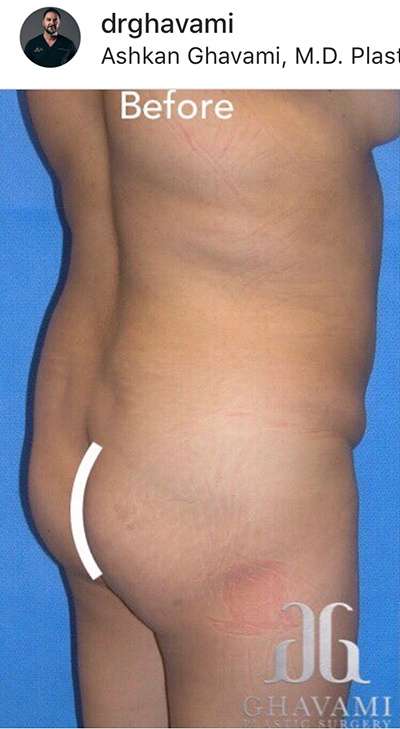 Breast and Body Before & After Patient #8360