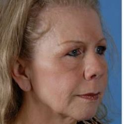 Browlift Before & After Patient #7770