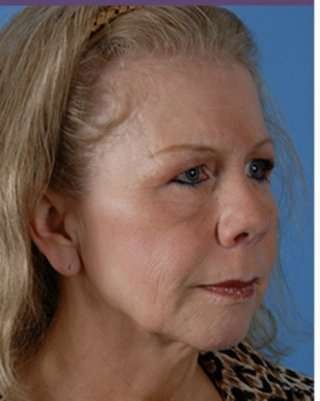 Browlift Before & After Patient #7770