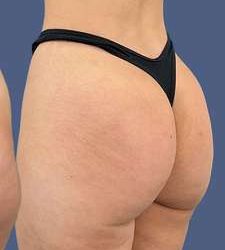 Buttock Augmentation Before & After Patient #7762
