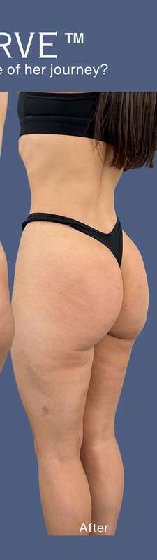 Buttock Augmentation Before & After Patient #7762