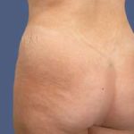 Buttock Augmentation Before & After Patient #7762