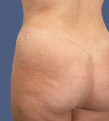 Buttock Augmentation Before & After Patient #7762