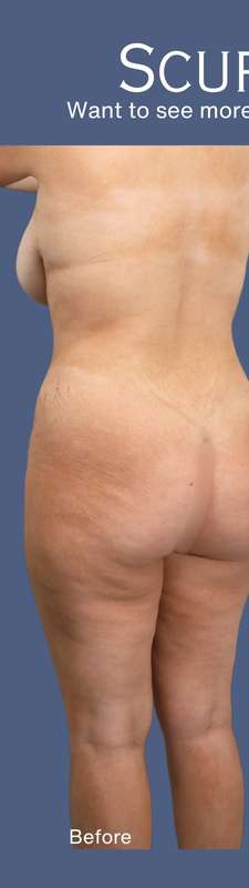 Buttock Augmentation Before & After Patient #7762