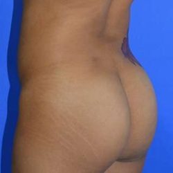 Buttock Augmentation Before & After Patient #7759