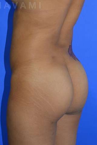 Buttock Augmentation Before & After Patient #7759